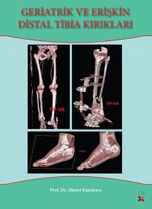 GERİATRİK VE ERİŞKİN DİSTAL TİBİA KIRIKLARI